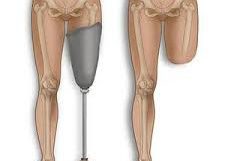 Ампутация ноги при сахарном диабете