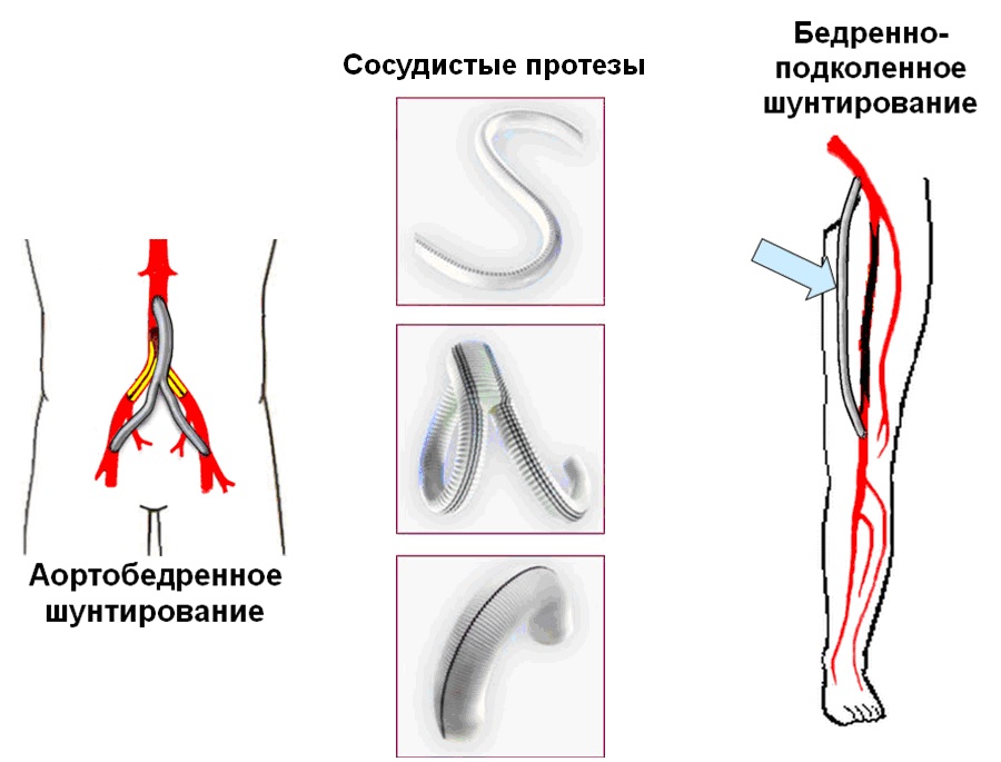 аорто-бедренное шунтирование, сосудистые протезы, бедренно-подколенное шунтирование аорто-бедренное шунтирование, сосудистые протезы, бедренно-подколенное шунтирование