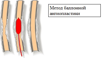 метод баллонной ангиопластики метод баллонной ангиопластики