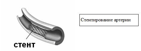 стентирование артерии стентирование артерии
