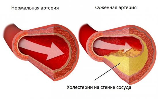 Холестериновые бляшки