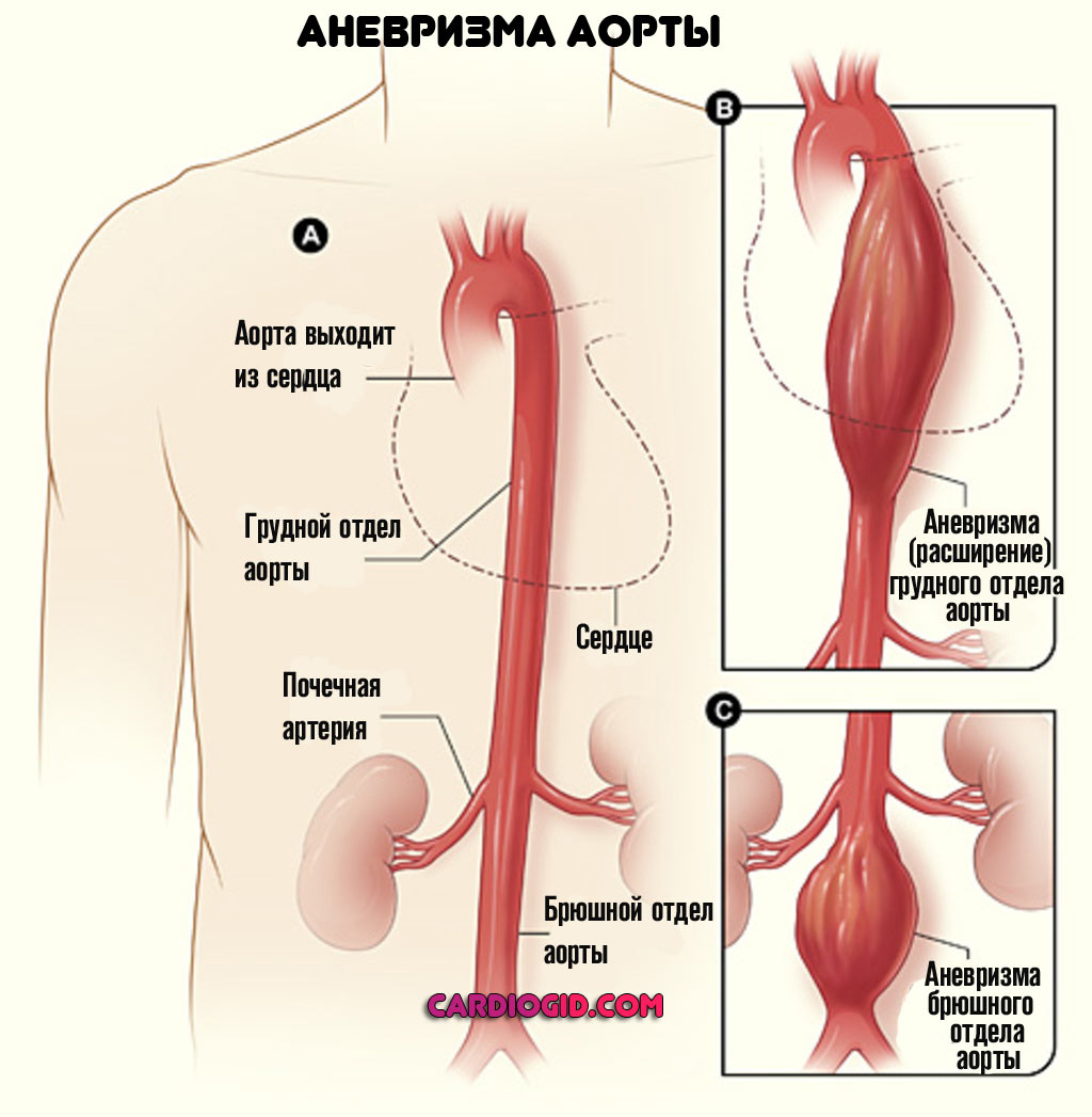 аневризма-аорты
