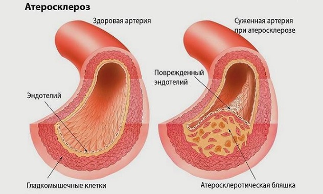 Атеросклероз сосудов