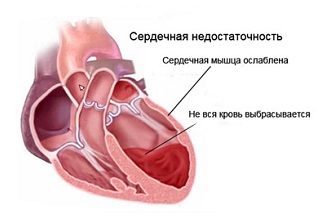 Сердечная недостаточность
