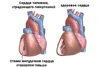 Как выглядит сердце человека страдающий гипертонией
