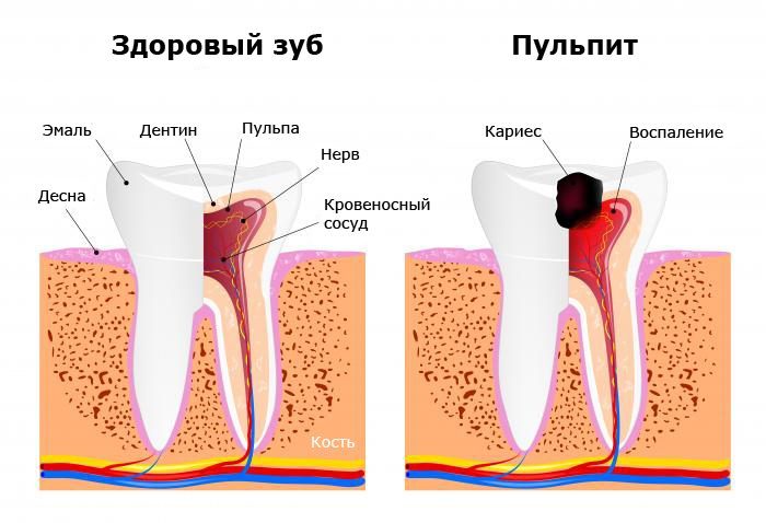 сравнение здорового зуба с кариесом