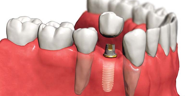 Что такое имплант зуба