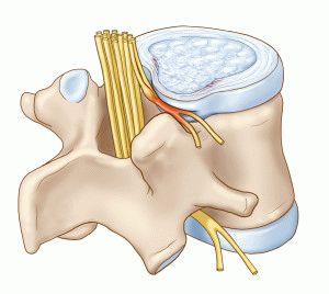 Грыжа позвоночника