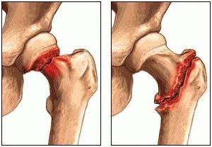 Перелом шейки бедра 