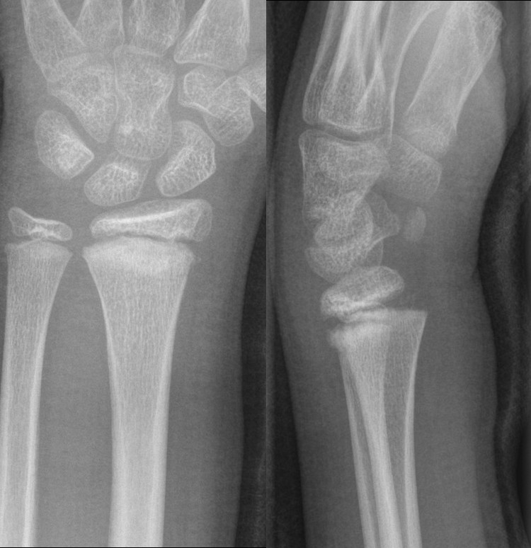 Salter-Harris 1 fracture of distal radius