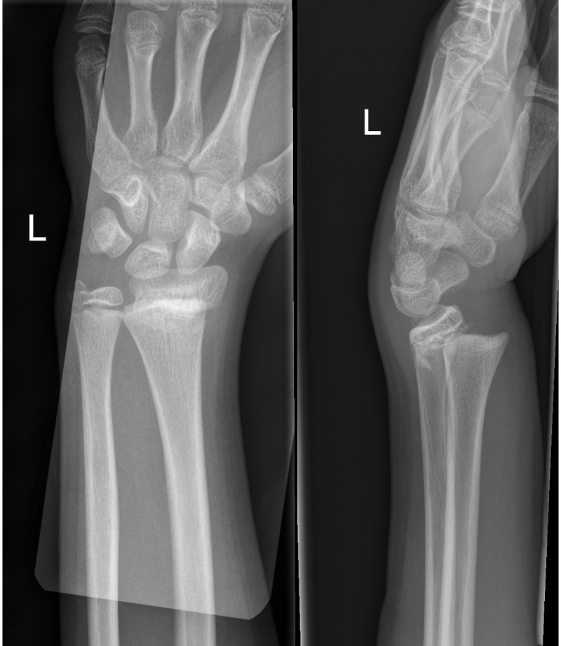 Salter-Harris II fracture with dorsal and radial displacement