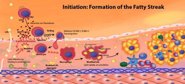 Формирование атеросклеротических бляшек