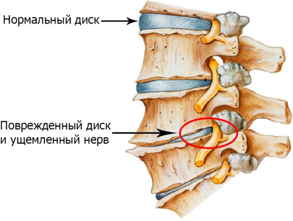 Поясничный остеохондроз