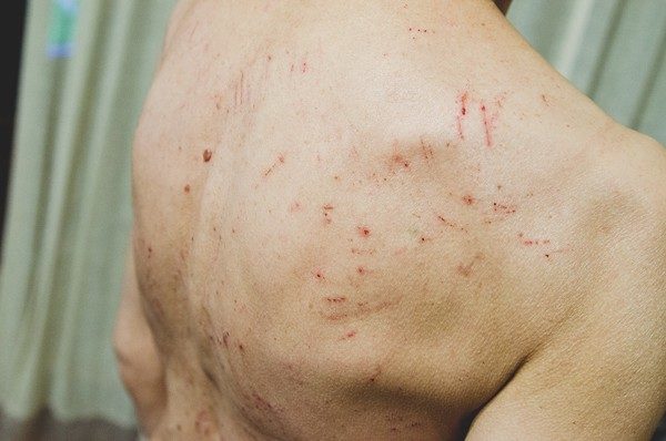 Разогревающие мази не наносят на кожу при имеющихся повреждениях (царапинах, сыпи, экземах)