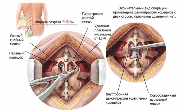 Удаление грыжи позвоночника