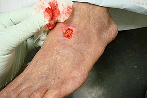 Артериальная язва периферические сосудов disease.jpg