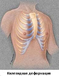 Деформации грудной клетки