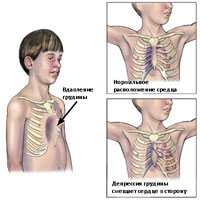 Деформации грудной клетки