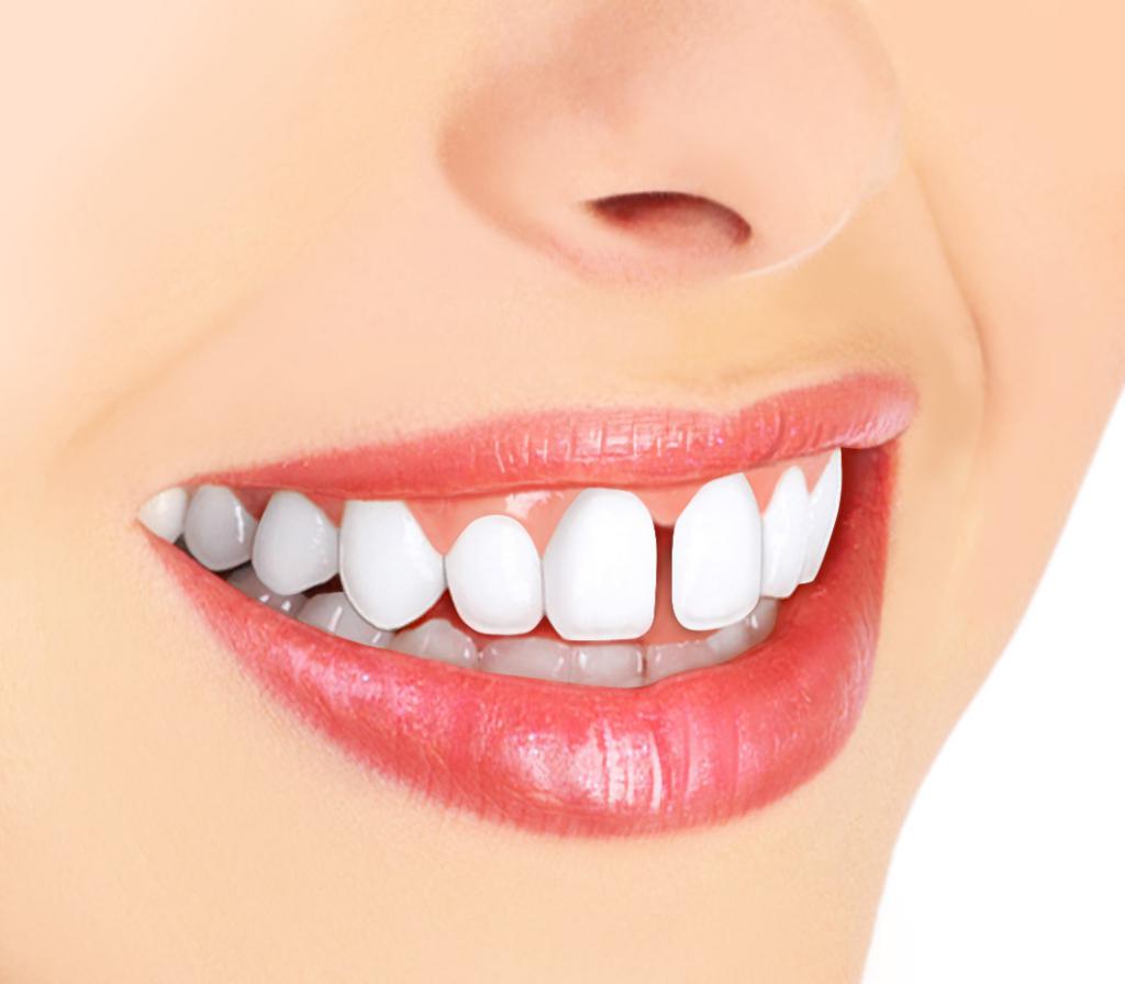 Как убрать щель между передними зубами?