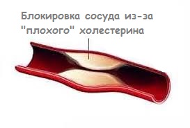 Блокировка сосуда из-за плохого холестерина