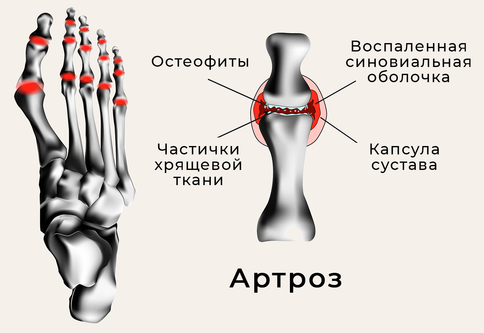 Артроз как причина боли