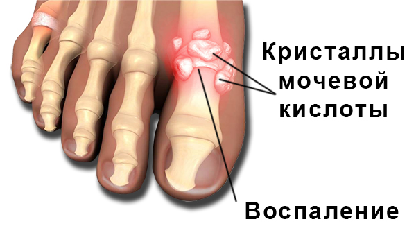 подагра как причина боли