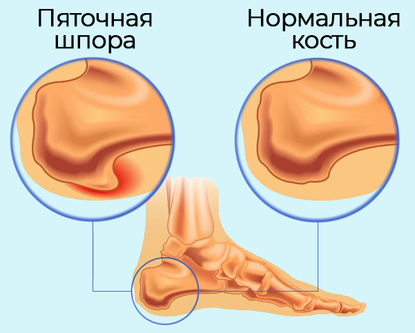 пяточная шпора - причина боли